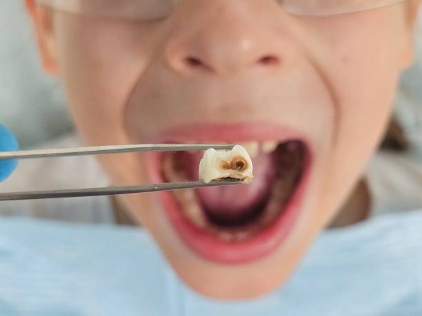 Best Emergency Tooth Extraction in Gardner, IL
